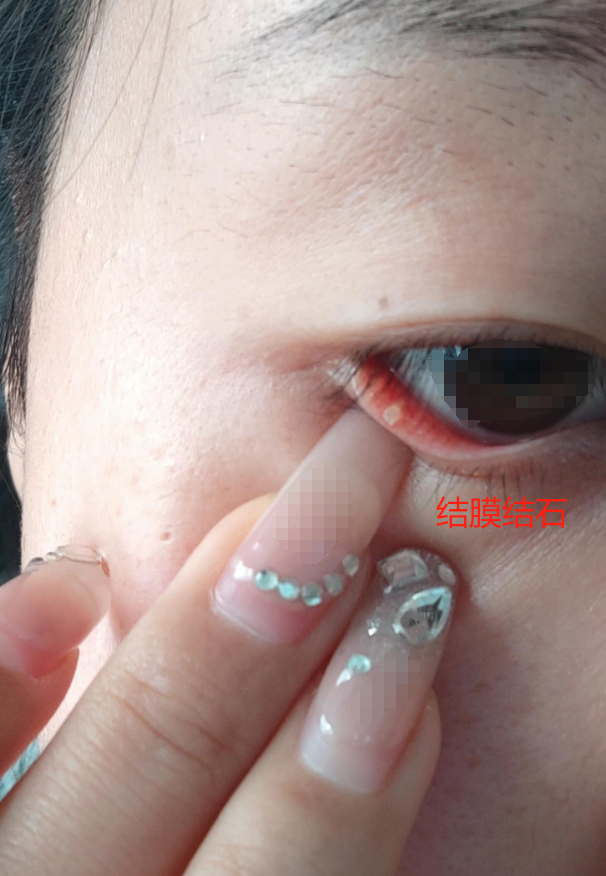 眼睛有异物感磨得慌