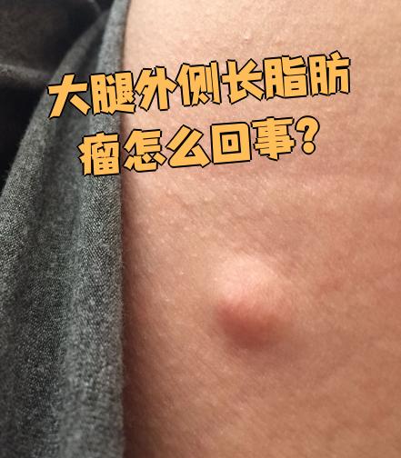 什么样子的是良性肿瘤?