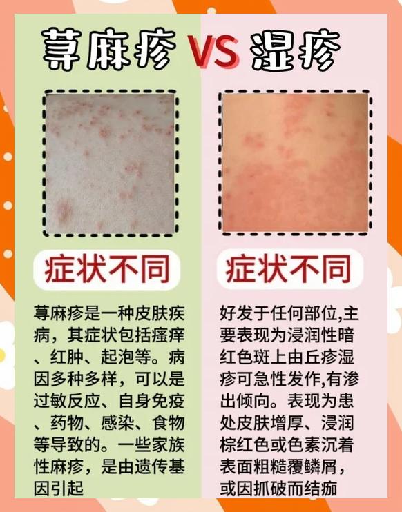 荨麻疹能根治吗?