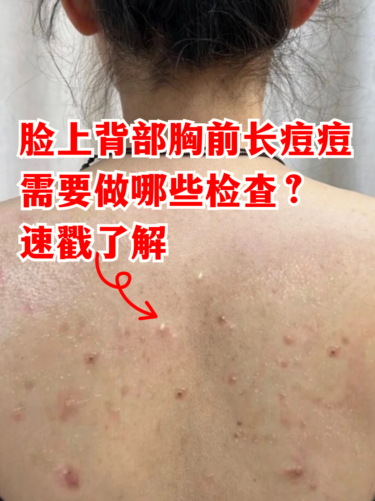 胸前长痘痘怎么办?