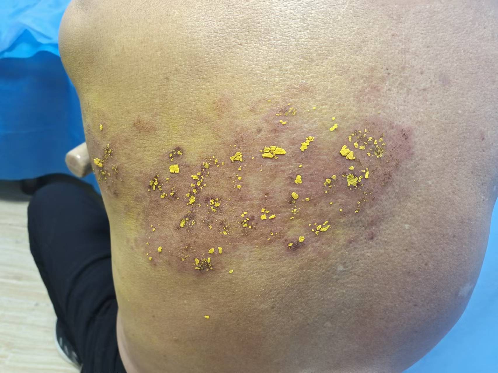 带状疱疹会带来哪些后遗症