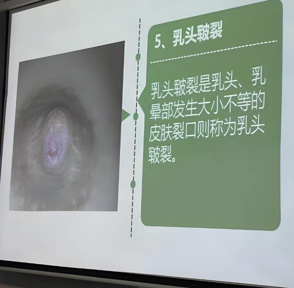 乳头裂开了是怎么回事?