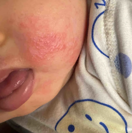 宝宝脸上有红点怎么办