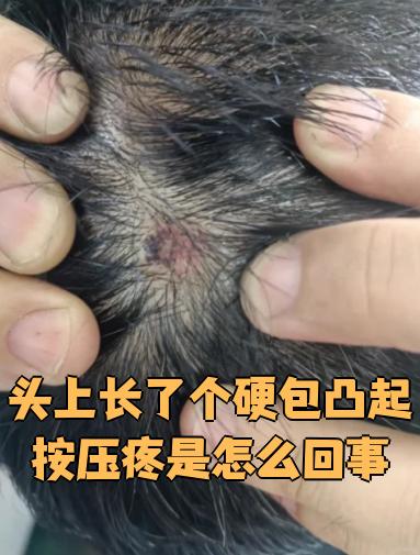 头上长肉疙瘩,怎么去除