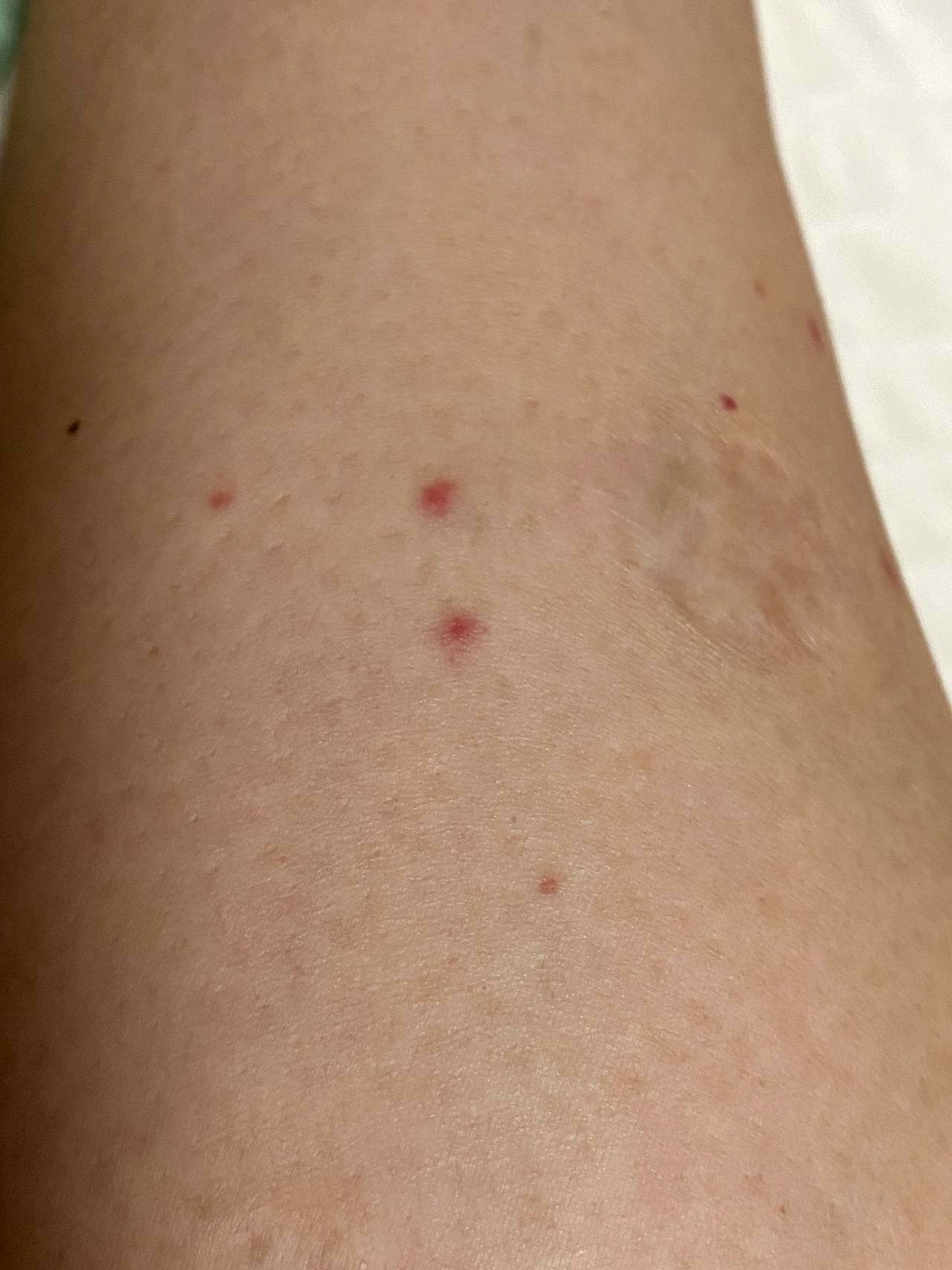 身上有小红点,不疼不痒