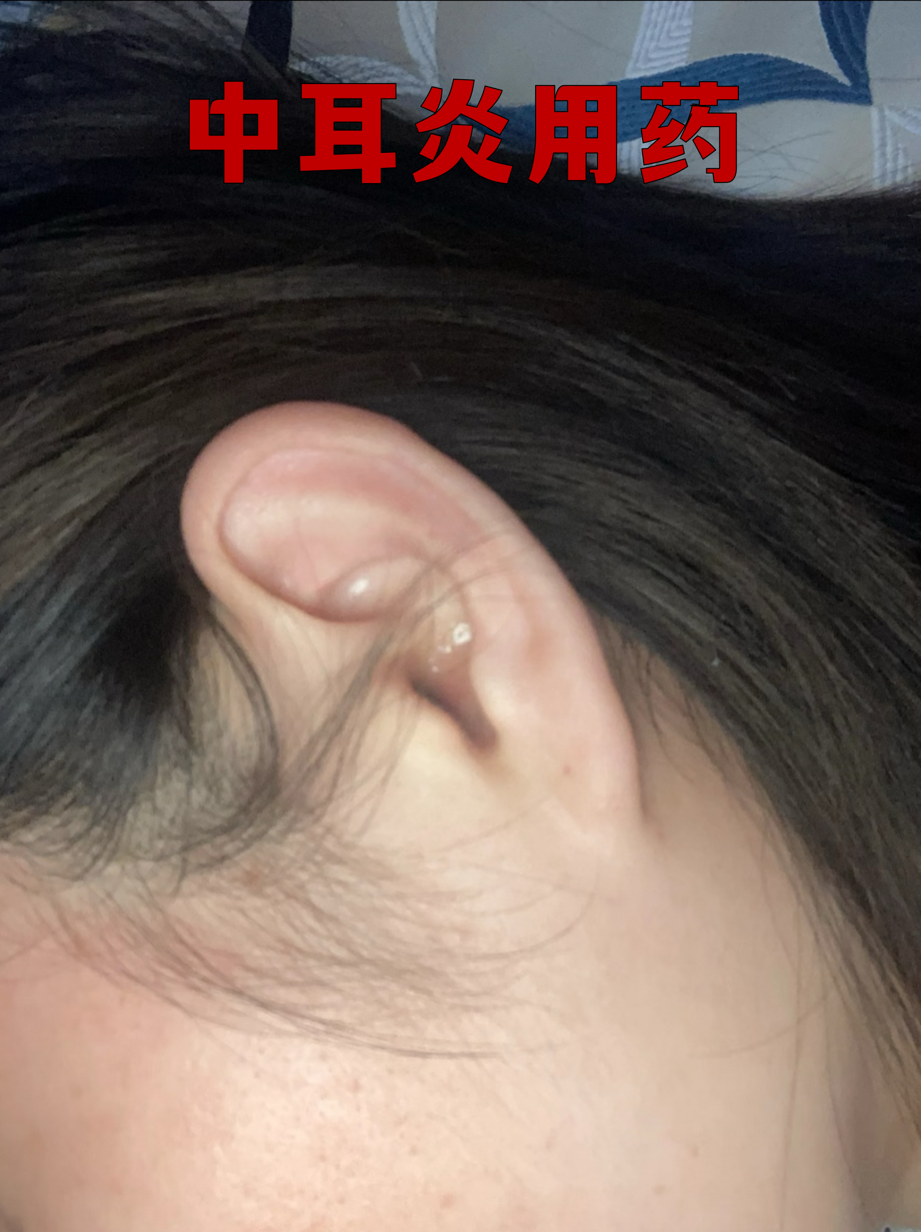 耳朵里面肿了一碰就疼怎么治疗