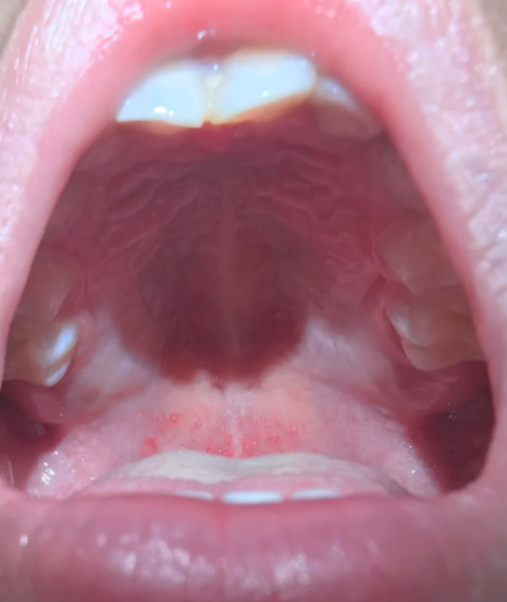 上颚起泡是什么原因