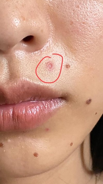 药水点痣留下的疤和这图片一样吗