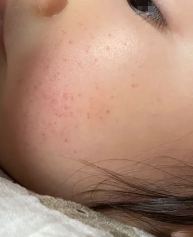 婴儿脸上起小红点是怎么回事?