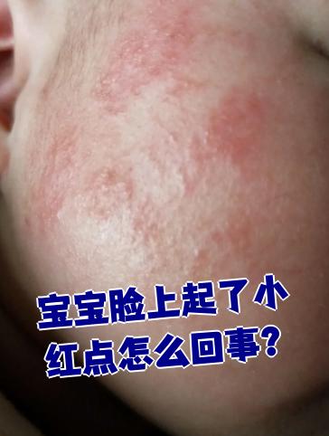 婴儿脸上起小红点是怎么回事?