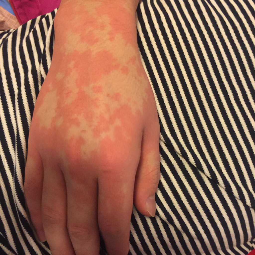 酒精过敏有什么症状?