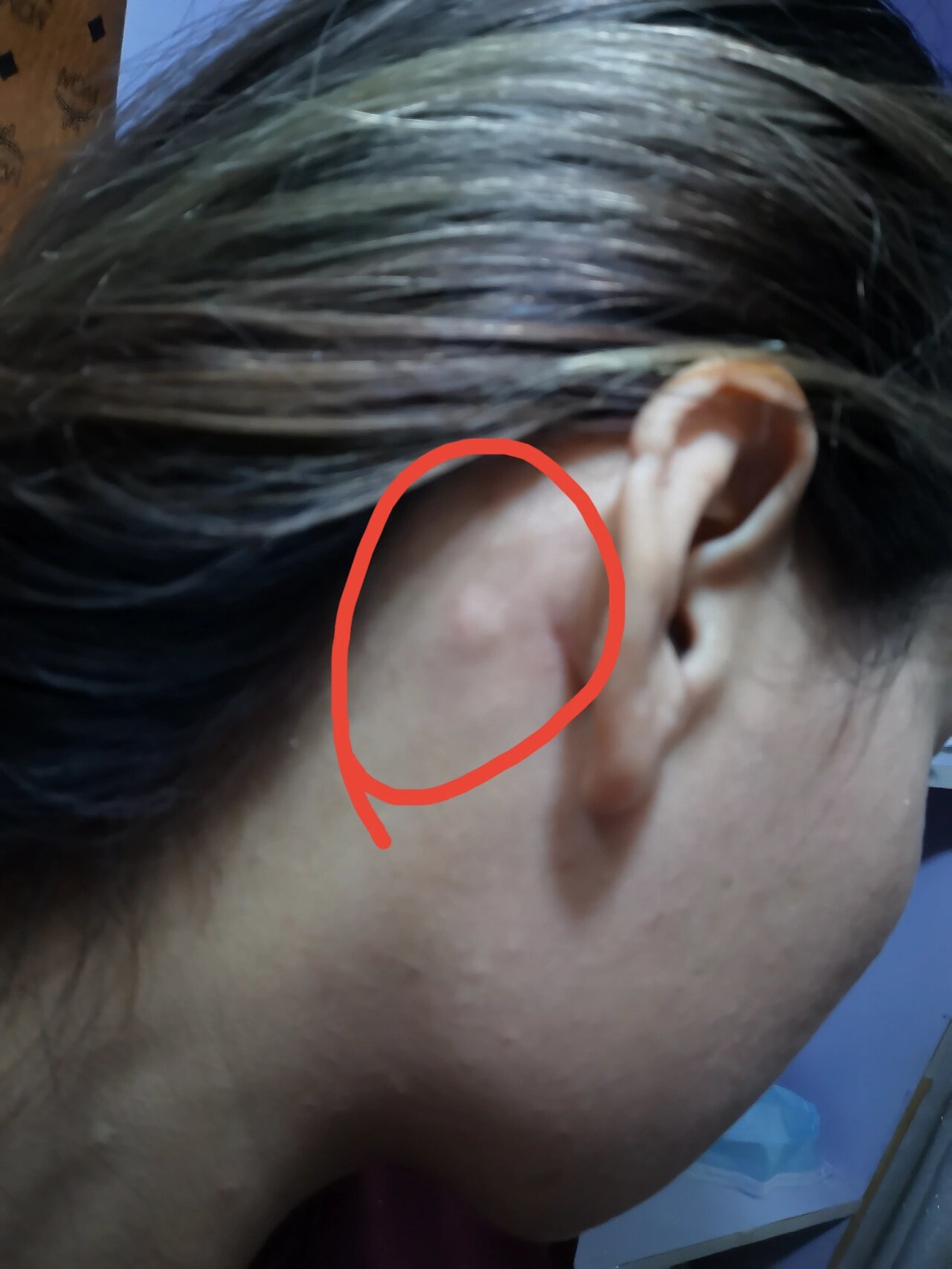 耳朵后面长了个硬包是什么