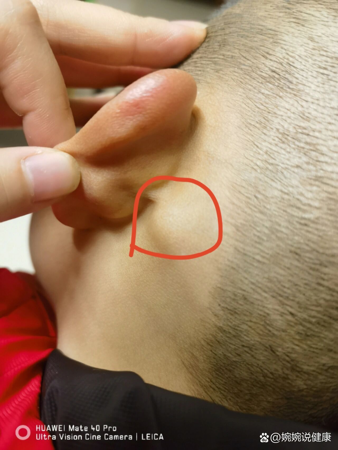 耳朵后面长了个硬包是什么