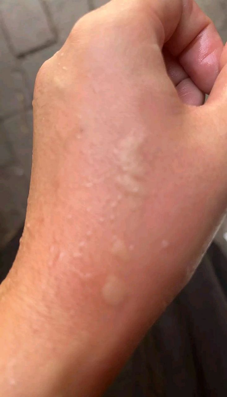 被洋辣子蛰了怎么办?