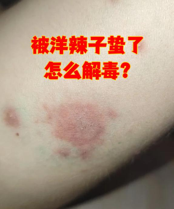被洋辣子蛰了怎么办?