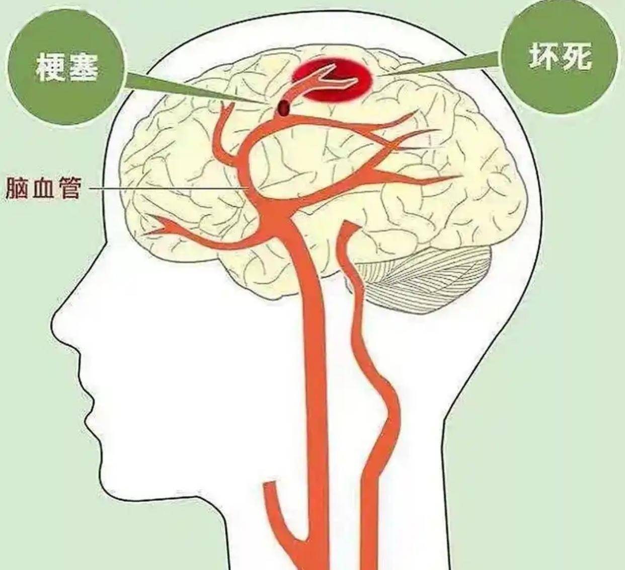 脑血栓的前兆有何症状表现