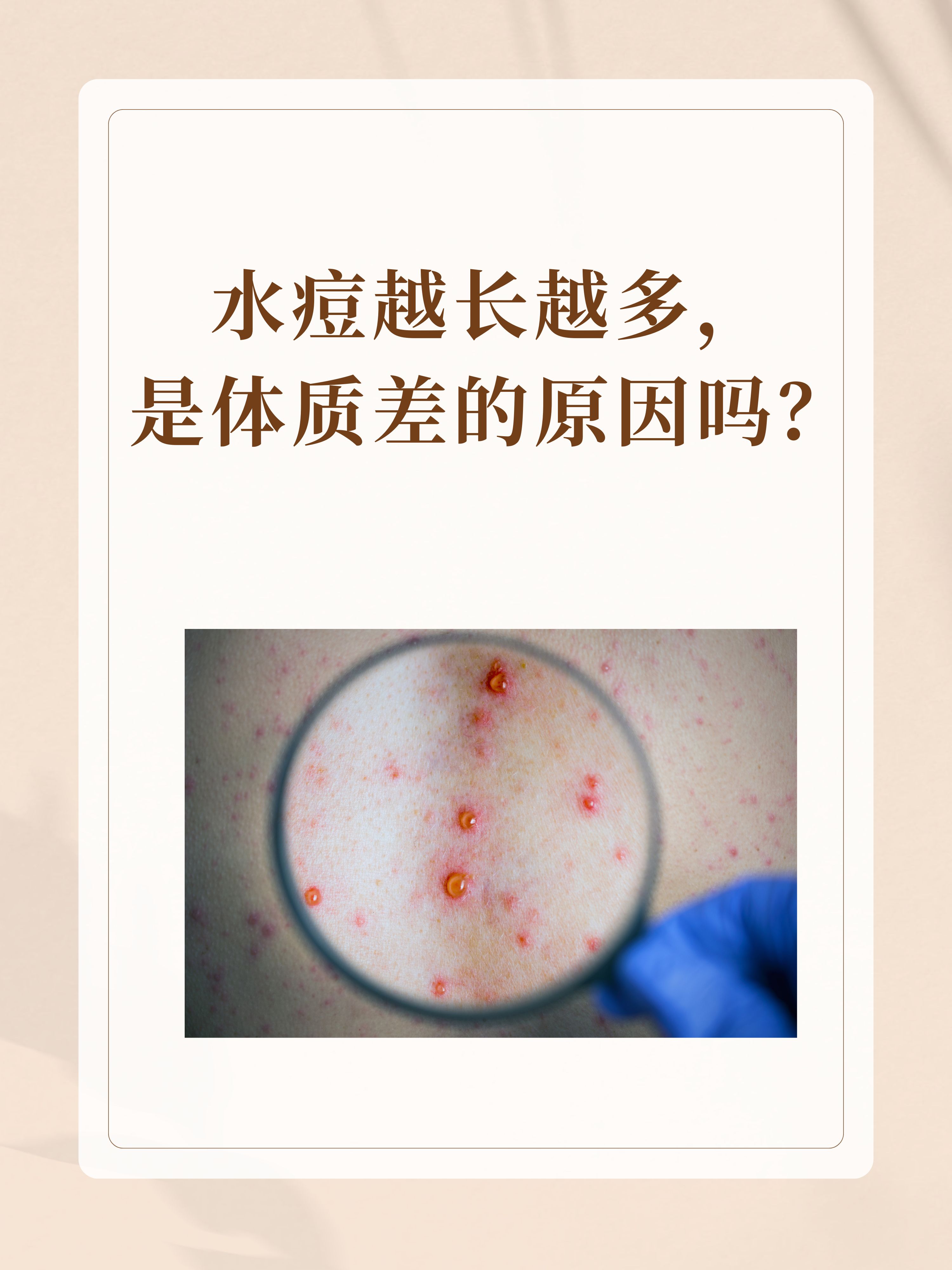 得了水痘怎么办,会传染吗?