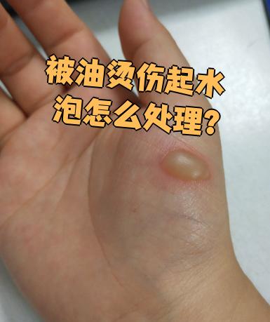 烫伤后起水泡要刺破吗