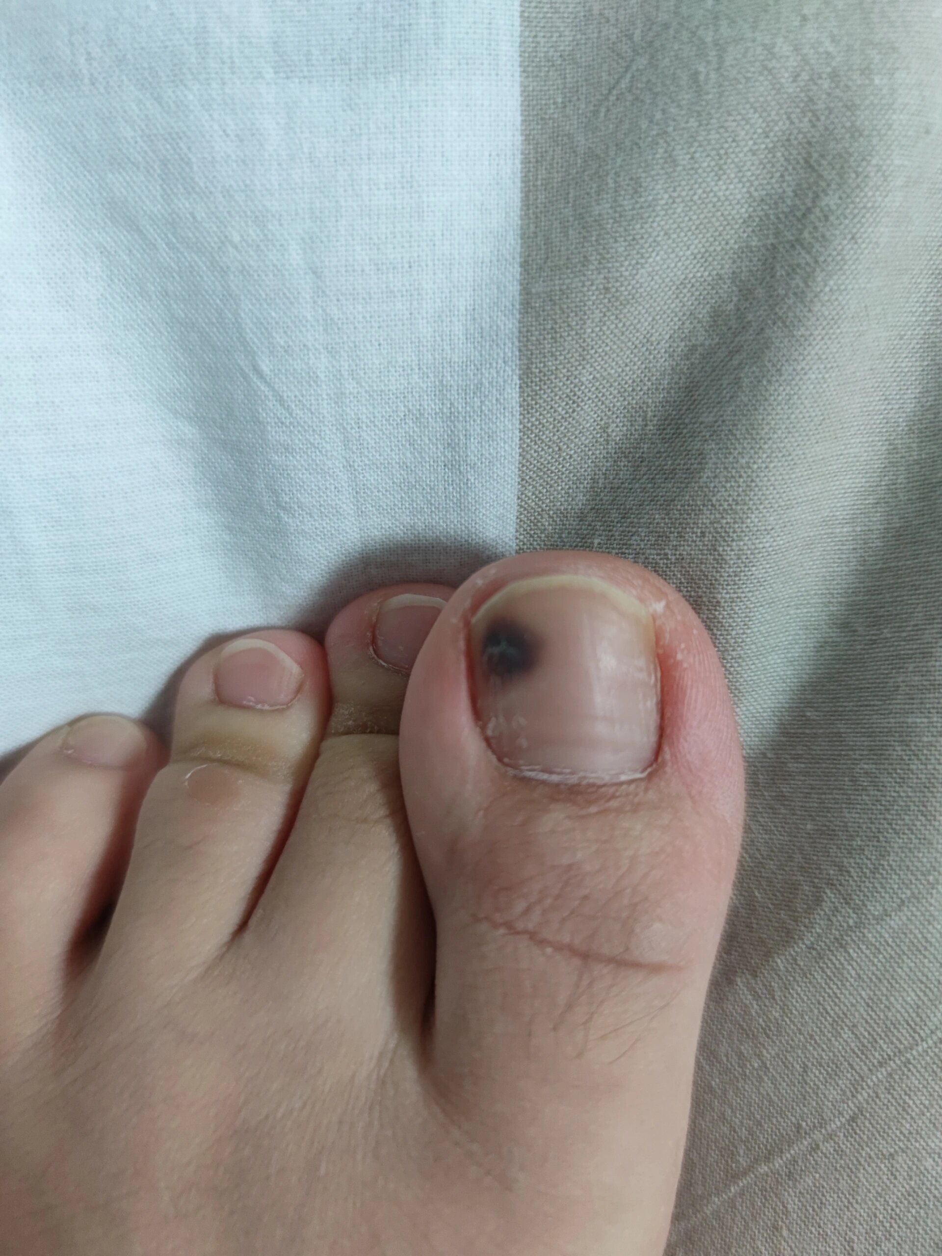 脚趾甲怎么变黑了是因为什么回事