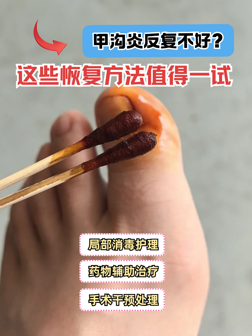 怎样治疗甲沟炎?