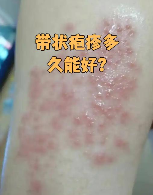 带状疱疹多久能够痊愈?