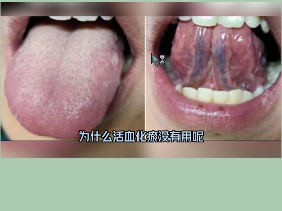 舌头下面青筋发黑