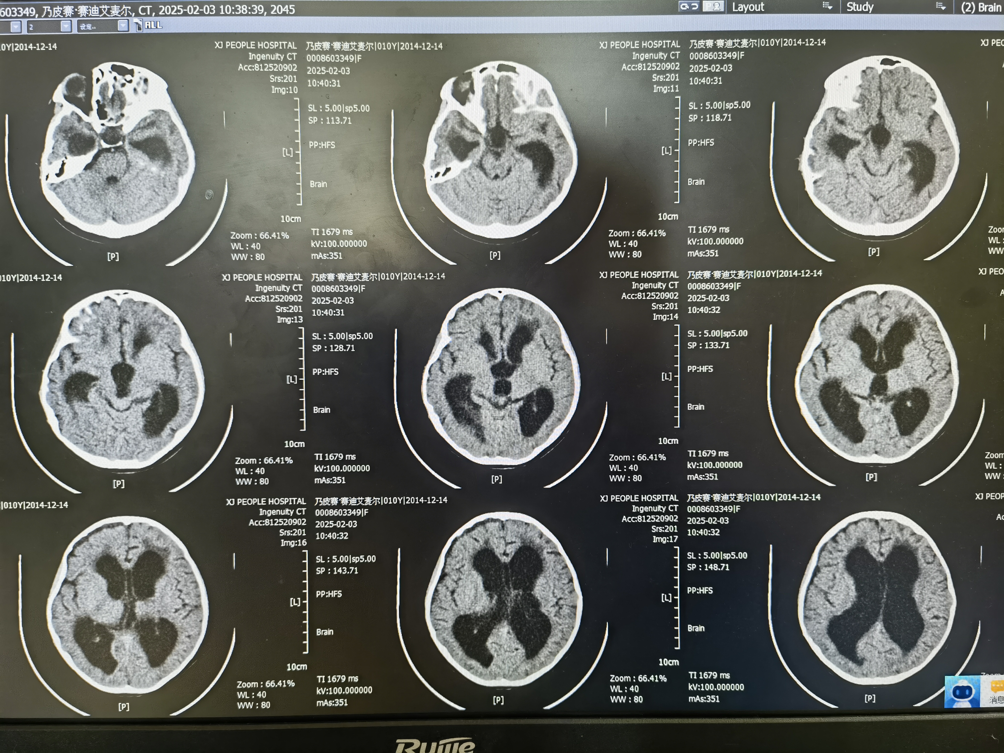 小儿脑积水什么造成的