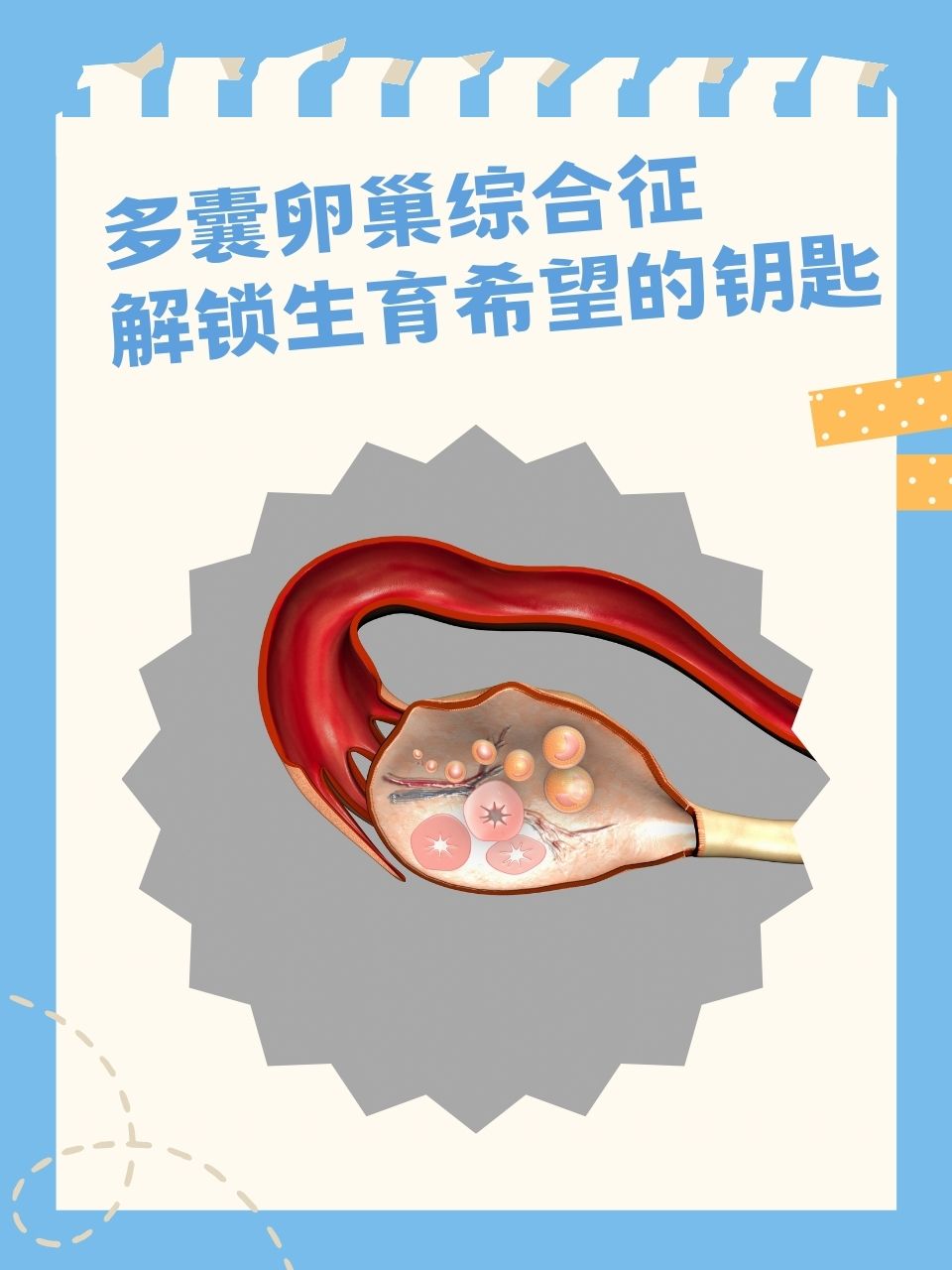 多囊卵巢综合征能生孩子吗