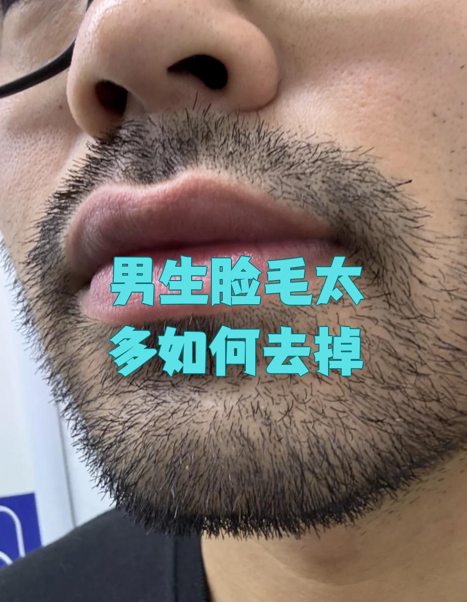 毛发旺盛怎么办