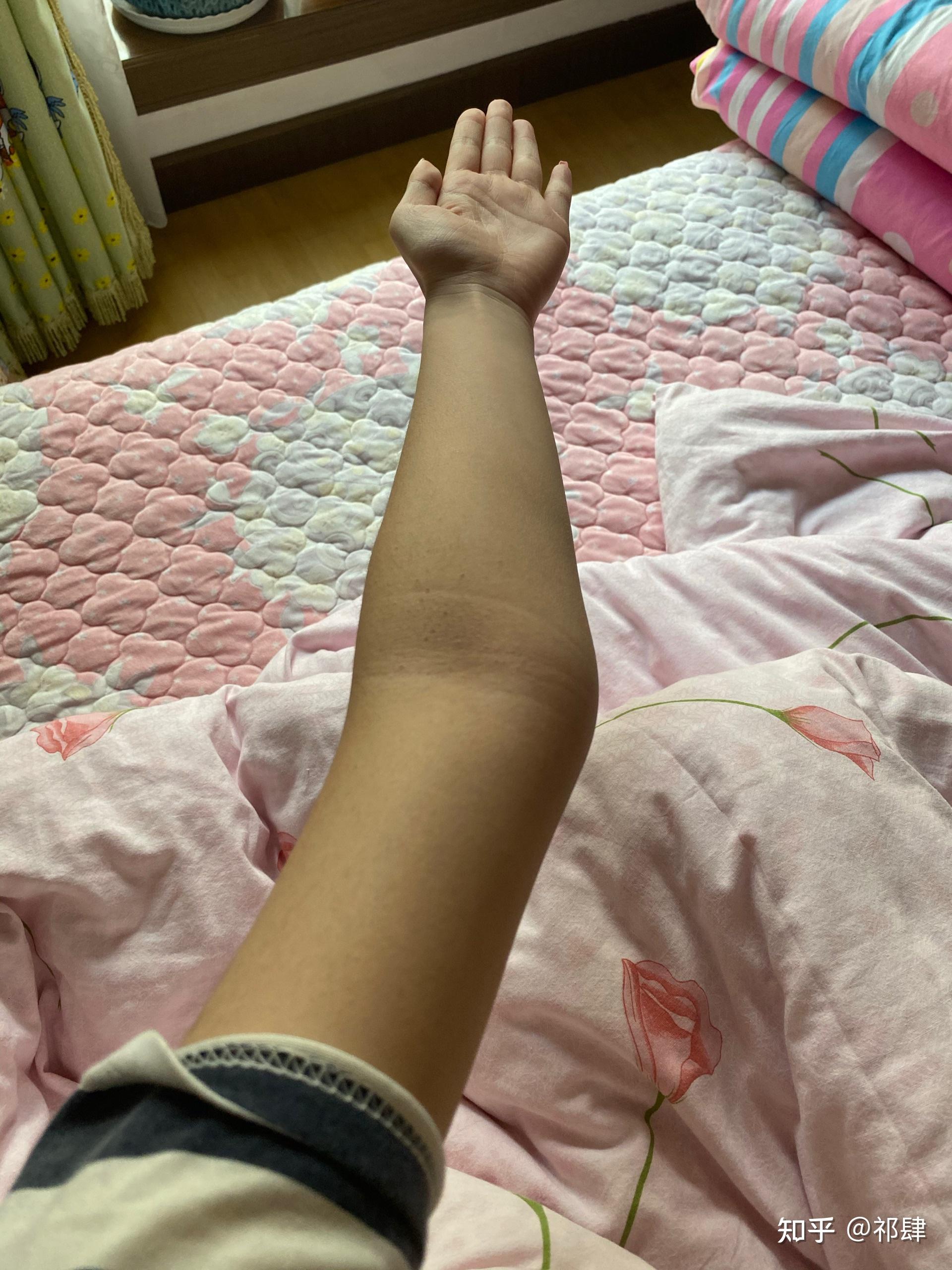 肘外翻的危害有哪些?