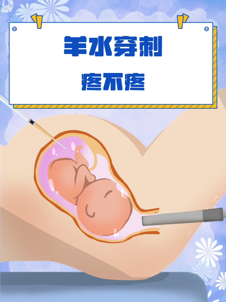 羊水穿刺是指什么