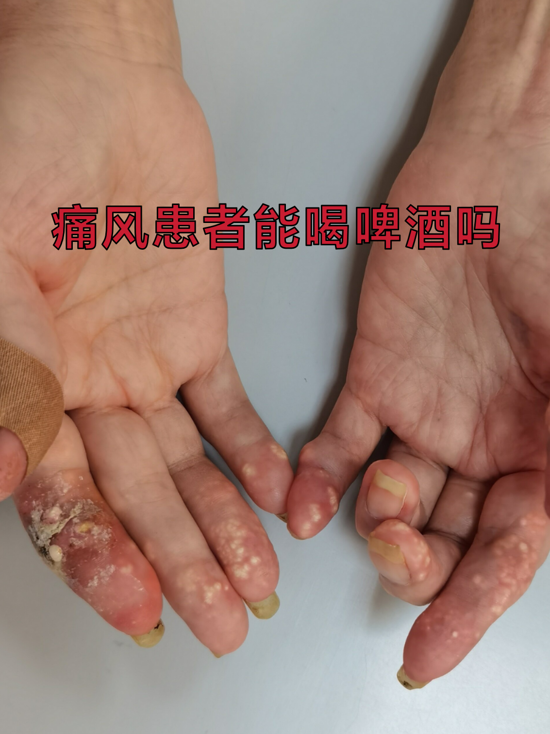 痛风可以喝白酒吗?