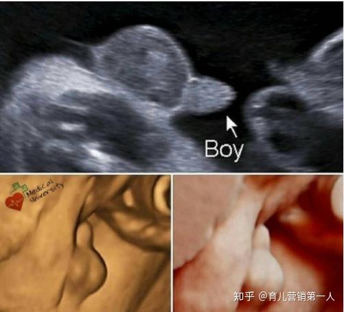 胎儿性别早知道