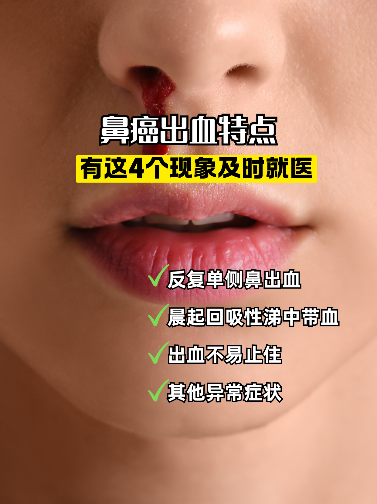 白血病流鼻血特点