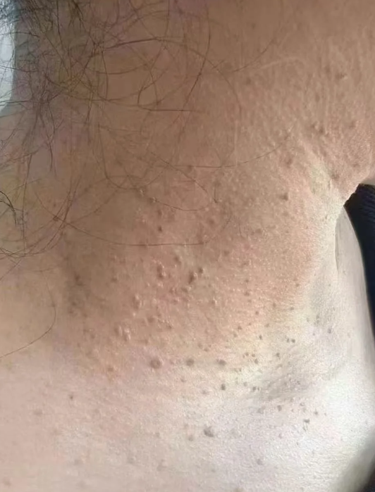 脖子上长很多小疙瘩是什么问题