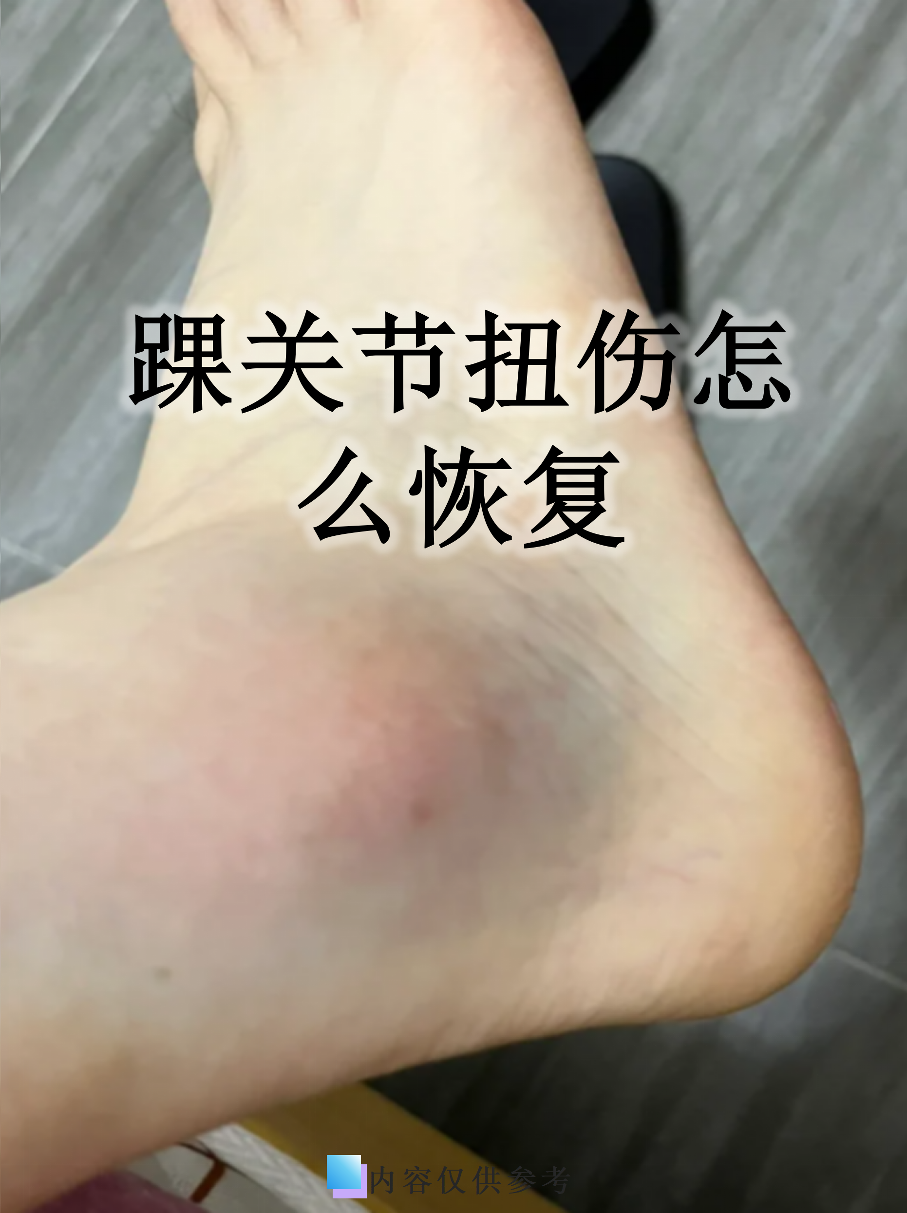 脚踝扭伤怎么恢复快?