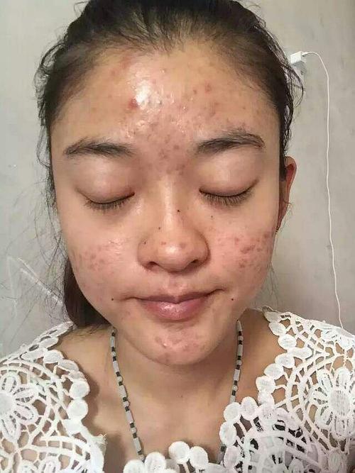 激素依赖性皮炎的症状有哪些?