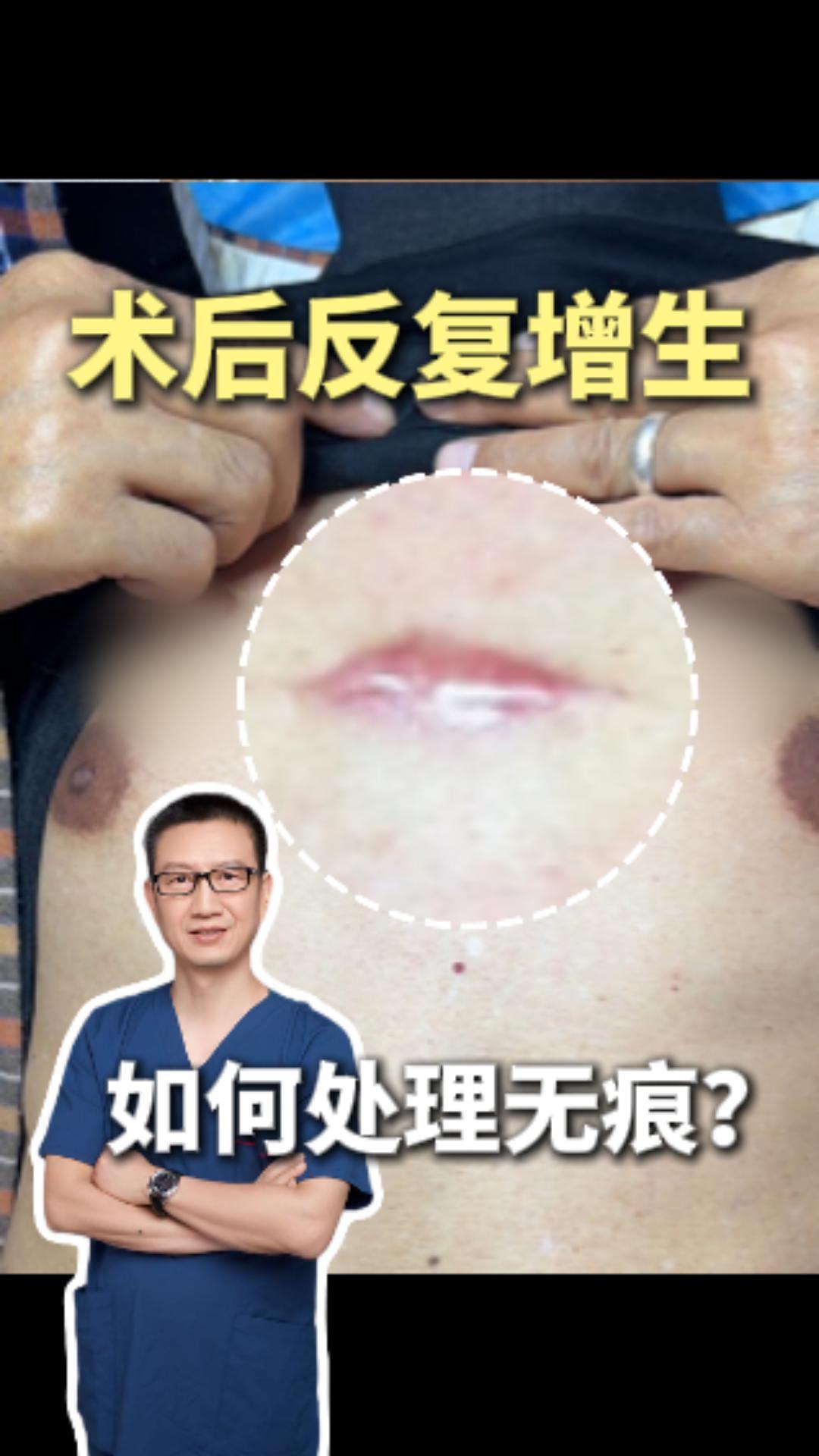 手术疤痕增生如何祛除