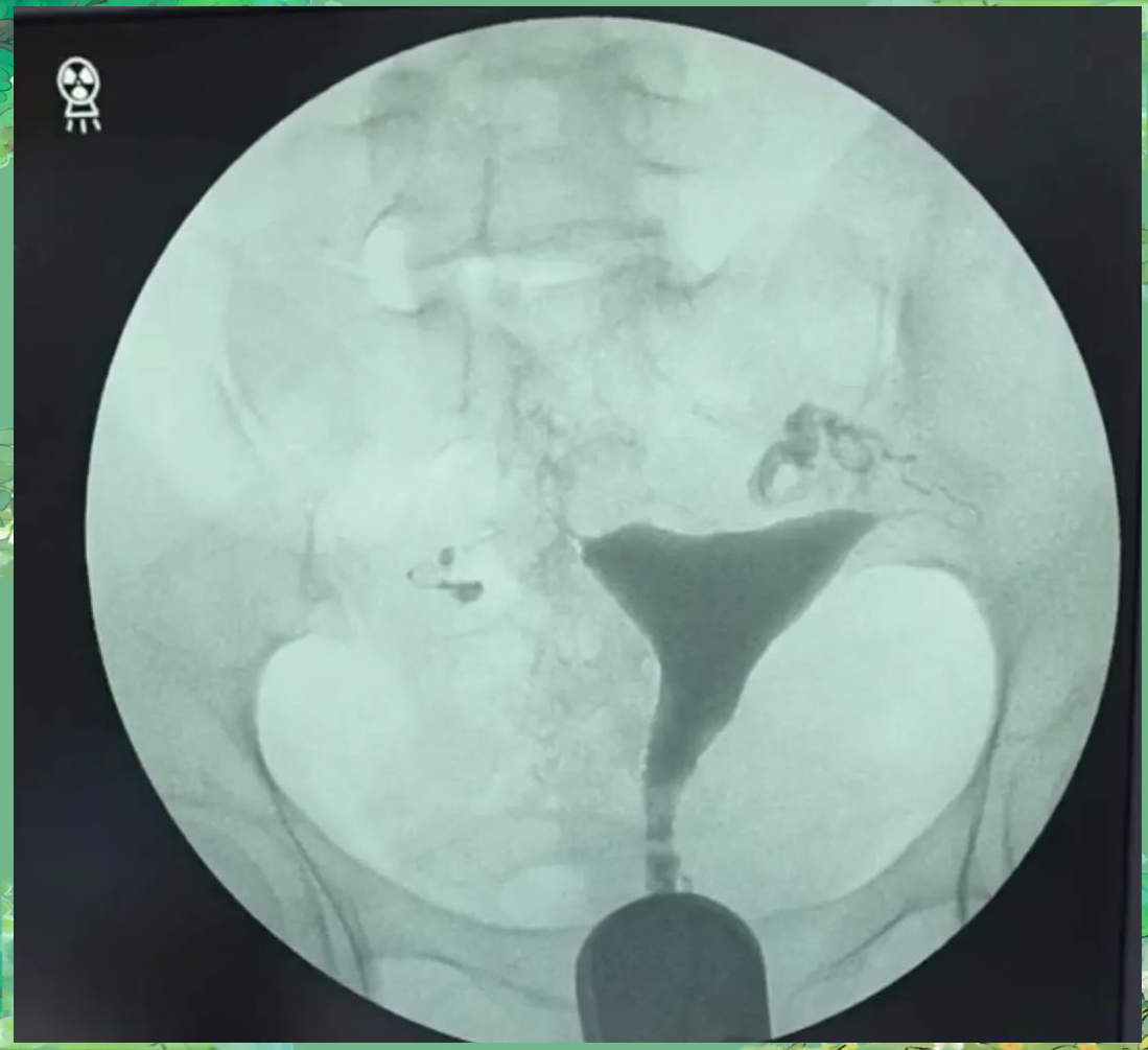 输卵管造影图片