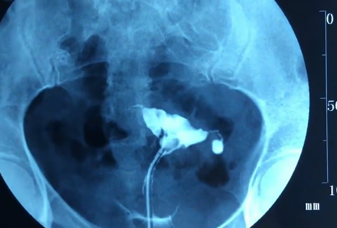 输卵管造影图片