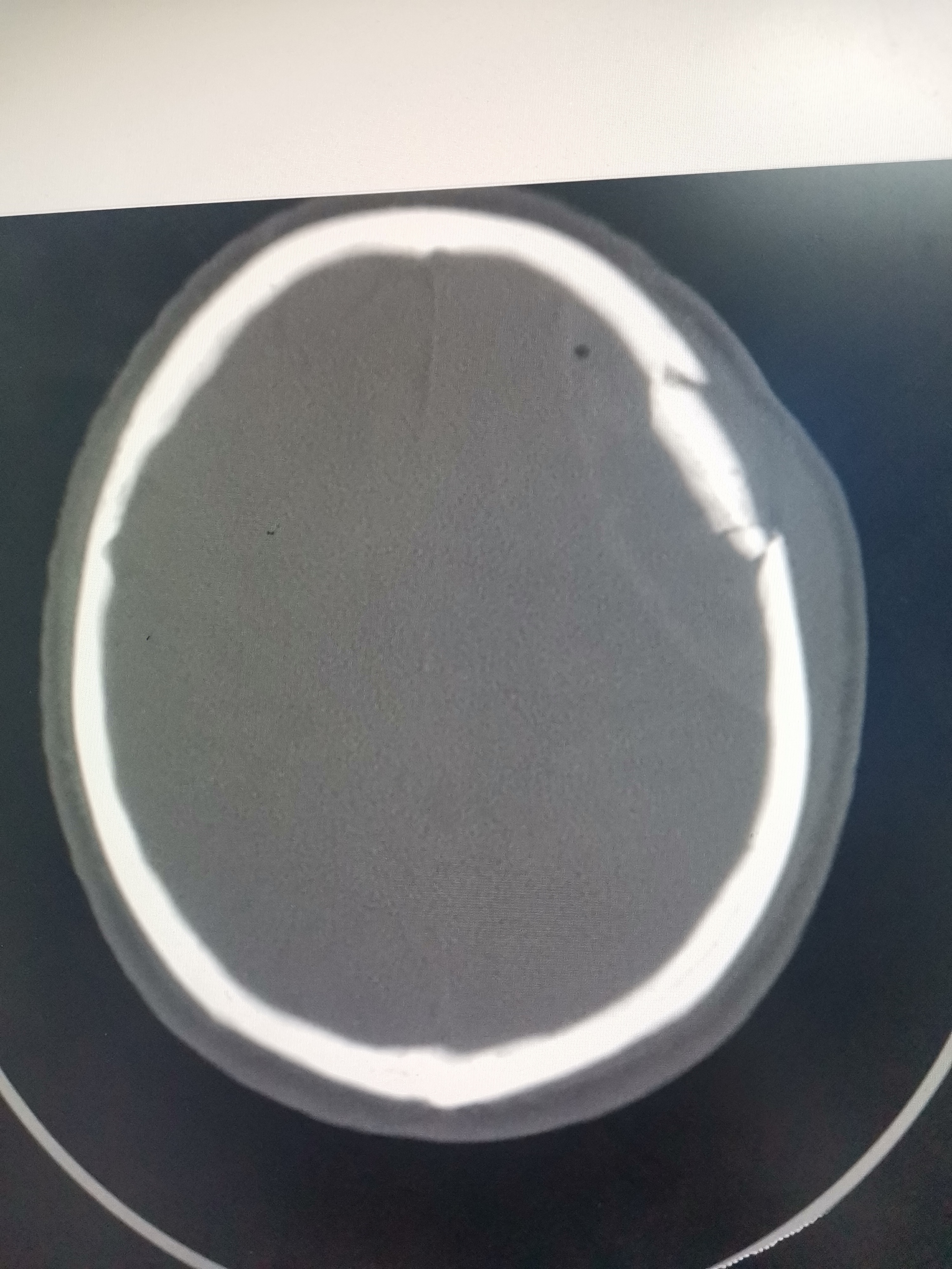 颅骨前窝骨折表现