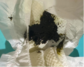 大便黑色是什么情况