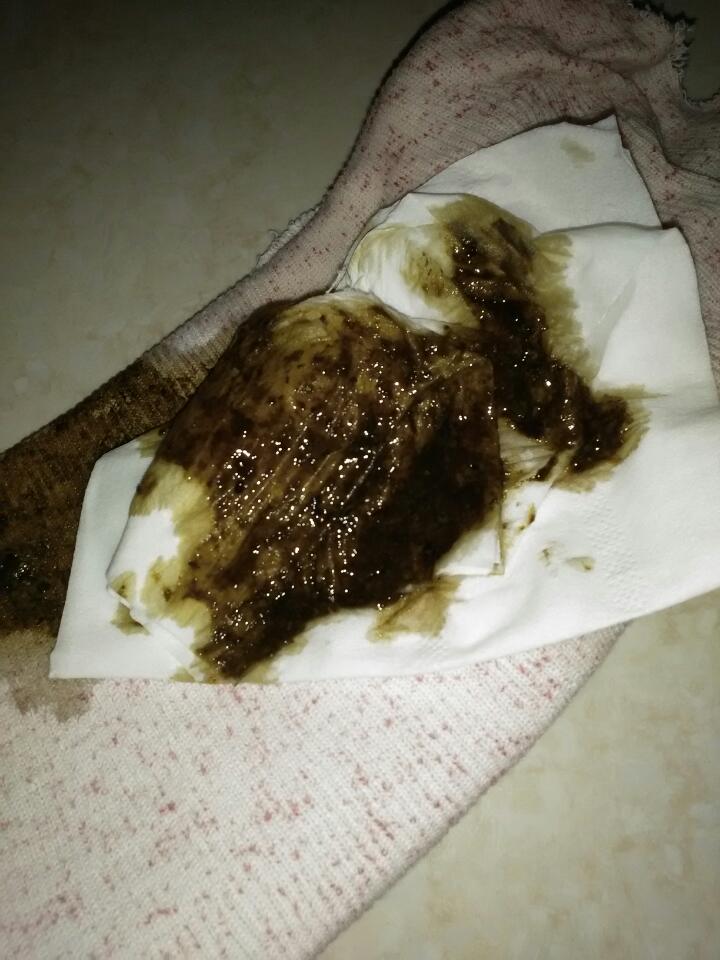 宝宝拉黑屎怎么回事?