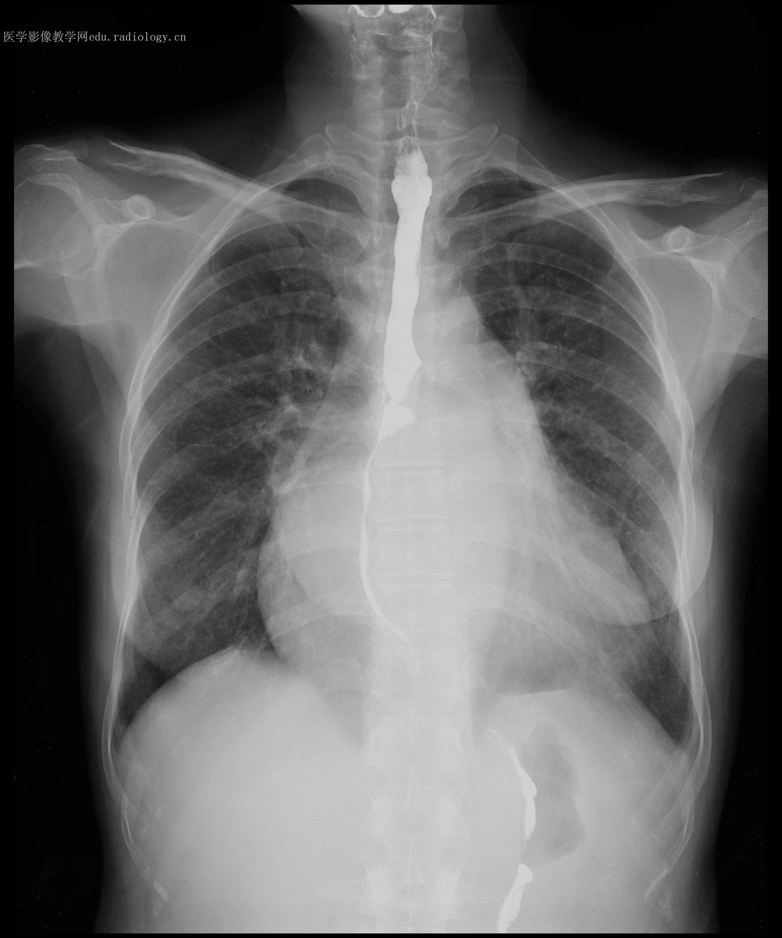 风湿性心脏病症状有哪些?