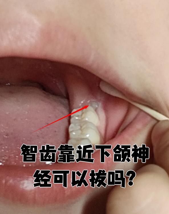 智齿横着长可以拔吗?