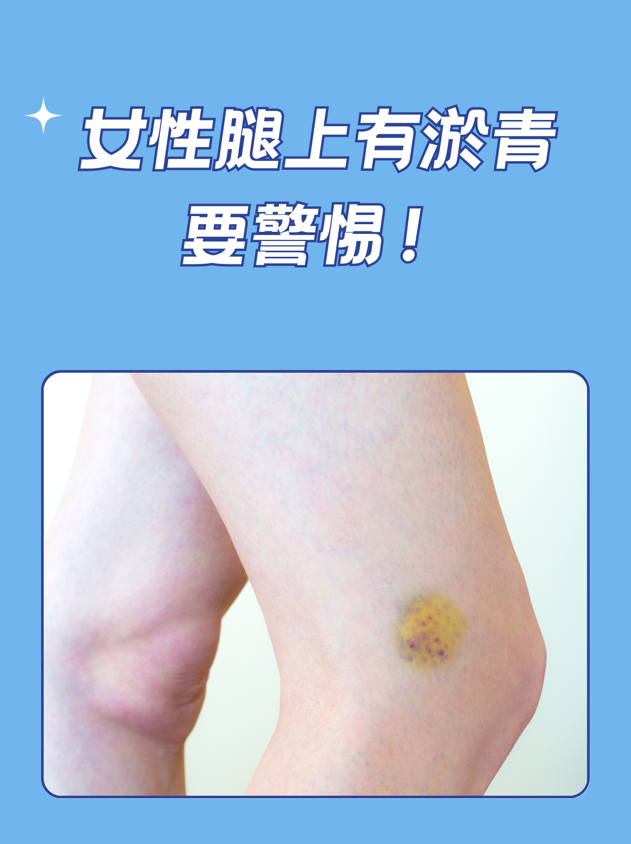 腿上有淤青如何消除