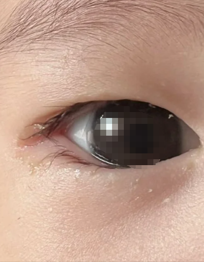新生儿眼睛有眼屎