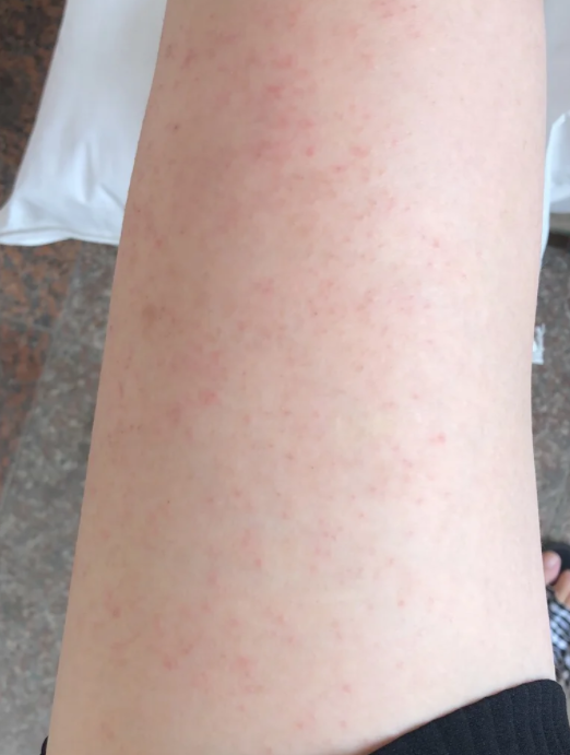 浑身痒一抓一片红疙瘩