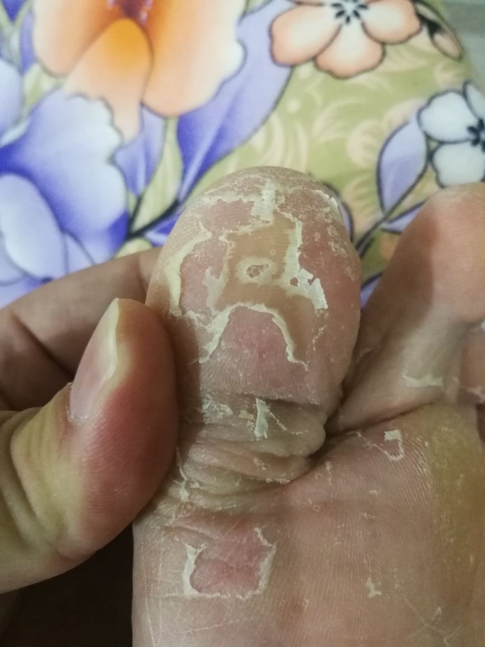 脚底大块脱皮,但不疼不痒