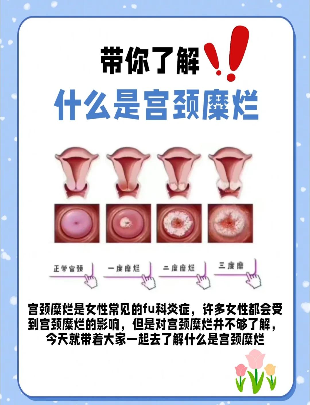 宫颈肥大是什么原因造成的